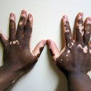 vitiligo