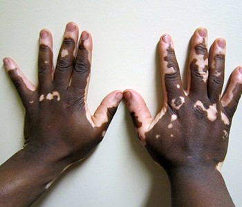 vitiligo