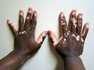 vitiligo